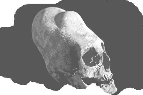 Paracas skull with prominent frontal cranium